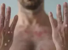 Zbulohet në Suedi rasti i parë i variantit të ri të Lisë së Majmunit jashtë Afrikës