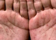 ALARM SHËNDETËSOR: Rritje e frikshme e rasteve me sifiliz në të rinjtë shqiptarë! Sifilizi është një sëmundje seksualisht e transmetueshme (SST) e shkaktuar nga një bakterie me emrin Treponema pallidum. Është një infeksion kronik, që ndjek një ecuri në disa faza, dhe nëse nuk diagnostikohet dhe trajtohet në kohë, mund të shkaktojë dëme të mëdha në tru, zemër, sy, sistem nervor dhe organe të tjera vitale, deri në verbim, paralizë ose vdekje.