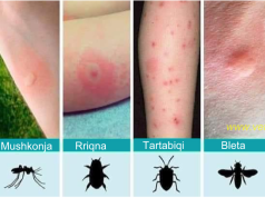 Stina e insekteve/ Mjekja: Çfarë duhet të dini për pickimet gjatë verës