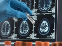 Si një analizë gjaku mund të zbulojë sëmundjen e Alzheimerit