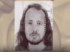 Tragjike: Shqiptari ndërron jetë pas transplantit të flokëve në Turqi