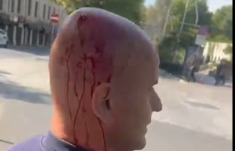 Ministria e Shëndetësisë: 17 të lënduar nga protesta po marrin trajtim, jashtë rrezikut